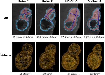 Evaluating automated longitudinal tumor measurements for glioblastoma response assessment